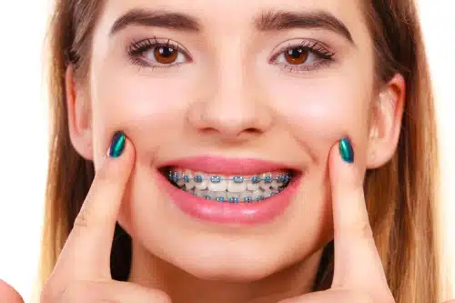 Braces